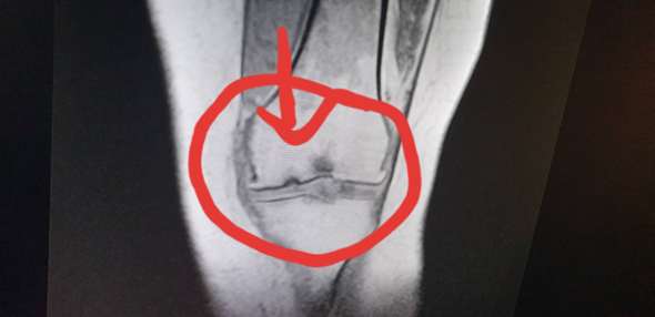 Erneute Osteochondrose dissecants oder etwas anderes?