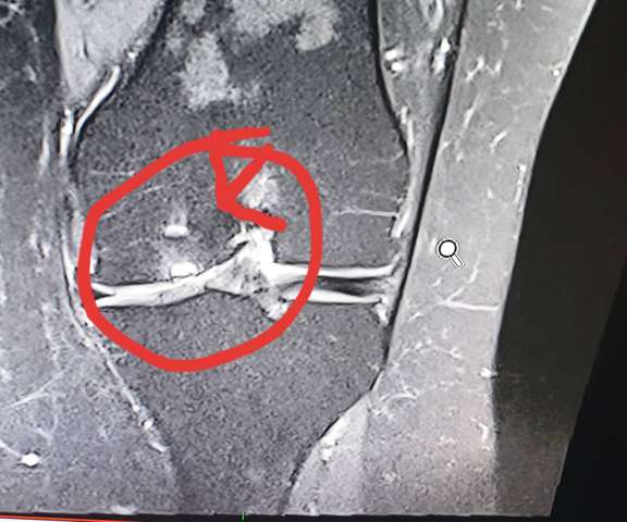 - (MRT, Osteochondrose)
