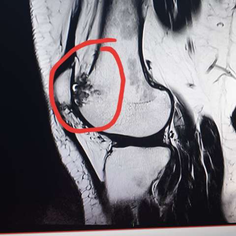 - (MRT, Osteochondrose)