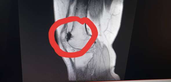 - (MRT, Osteochondrose)