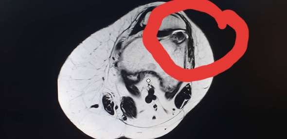 - (MRT, Osteochondrose)