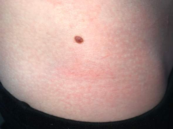 Etwas Schwarzer Fleck Auf Muttermal Ohne Etwas Weiters Zu Sehen Schmerzen Haut Etwas Schwarzer Fleck Auf Muttermal Ohne Etwas Weiters Zu Sehen Schmerzen Haut