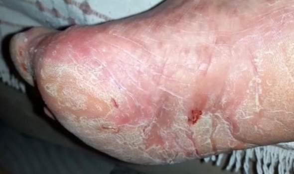Extrem rissige blutige Füße. Kann jemand helfen?