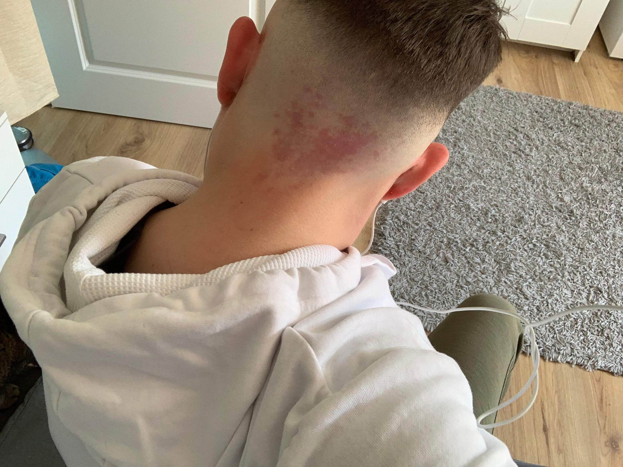 Feuermal oder was kann das sein? (Gesundheit, roter-fleck, Hinterkopf)