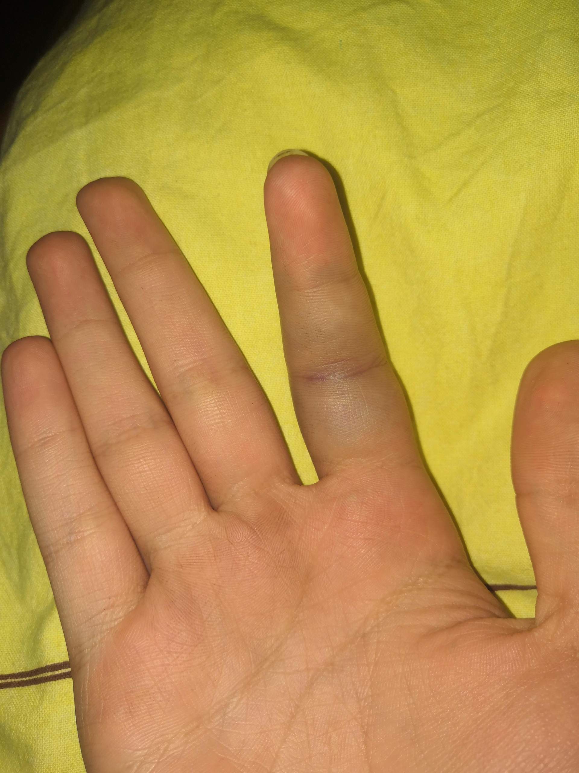 Wie Sieht Ein Gebrochener Finger Aus
