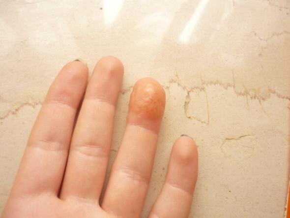 Finger geschwollen! Pflasterallergie?