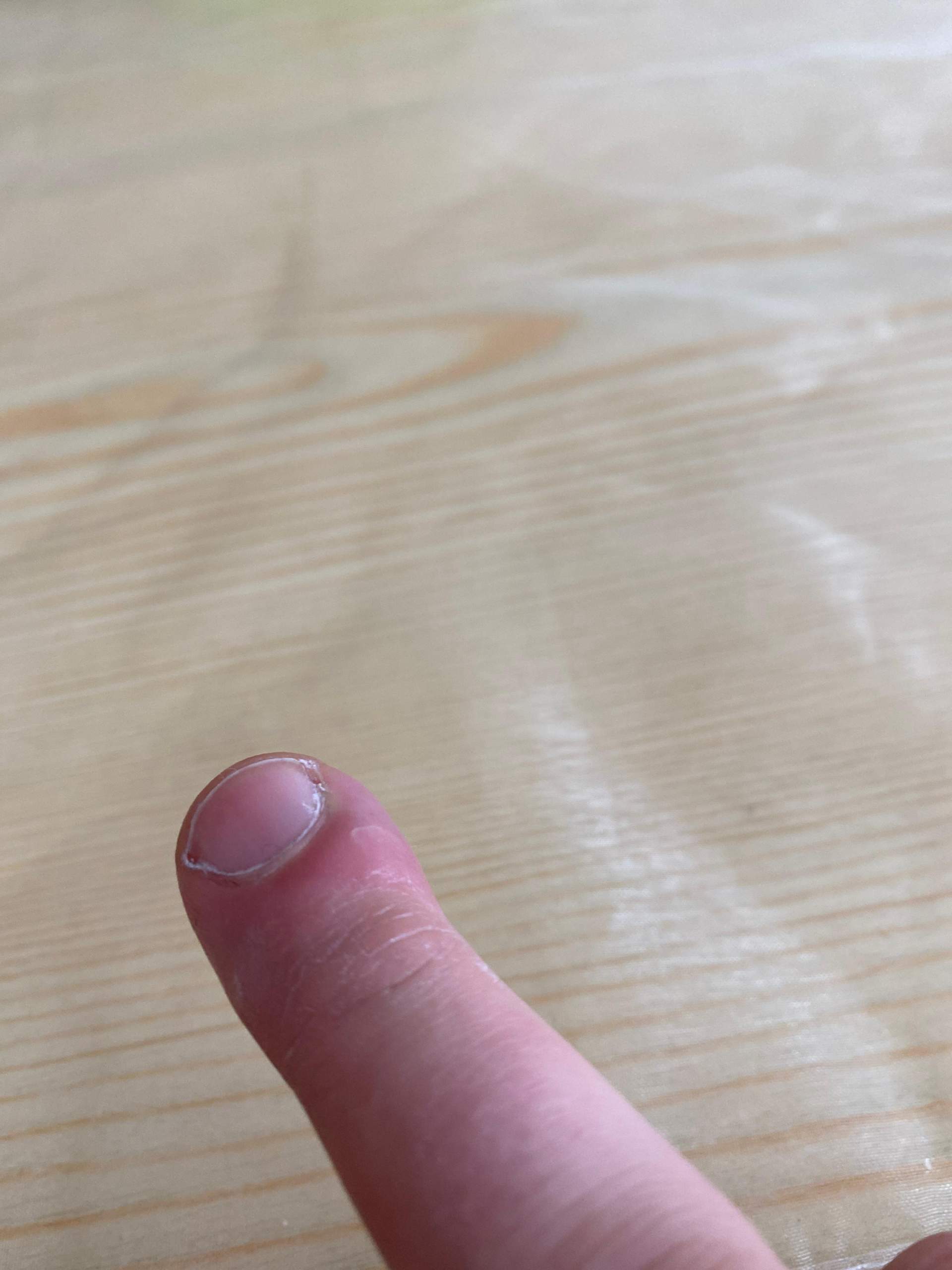 Finger geschwollen was tun? (Schmerzen, Haut, Schwellung)