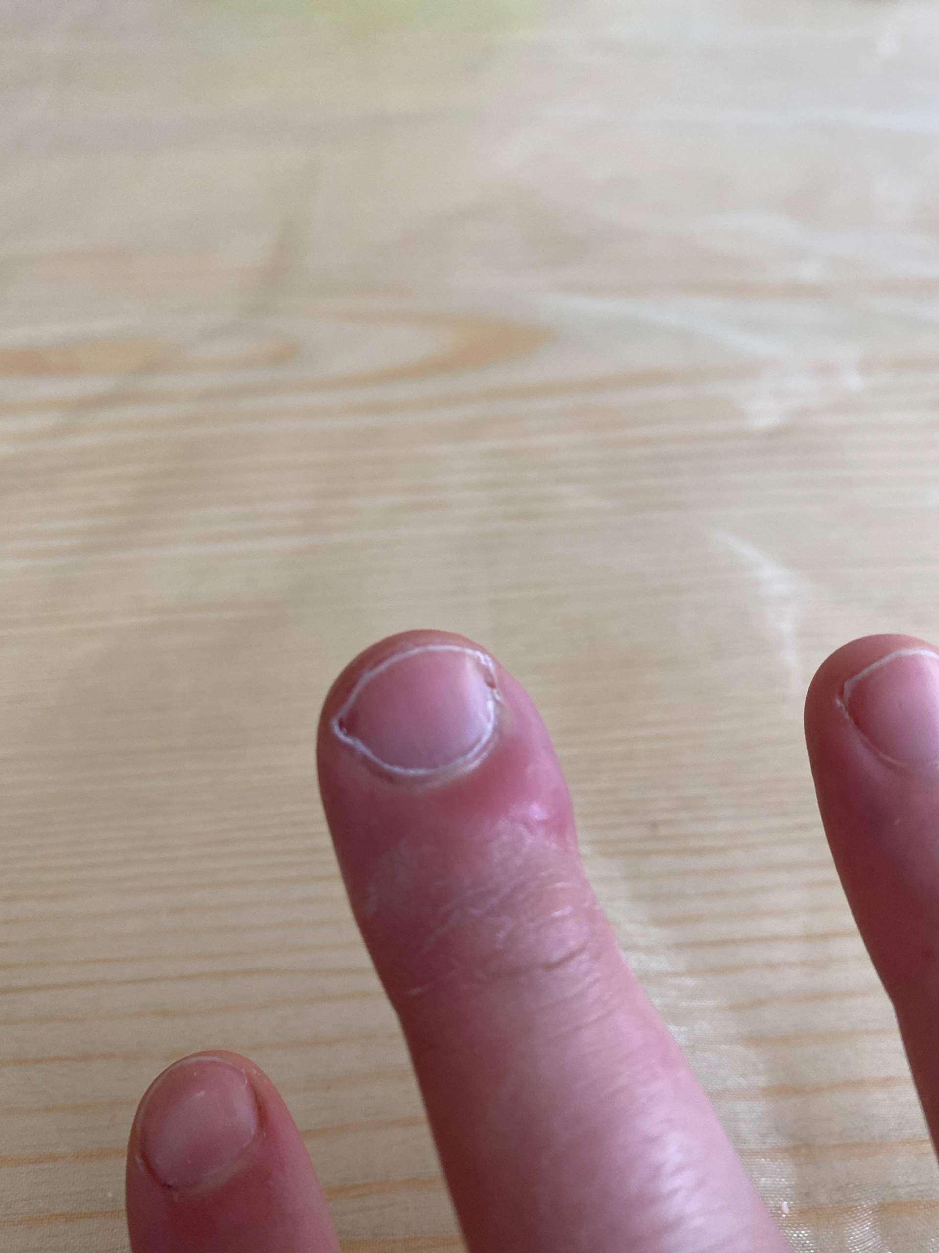 Finger geschwollen was tun? (Schmerzen, Haut, Schwellung)