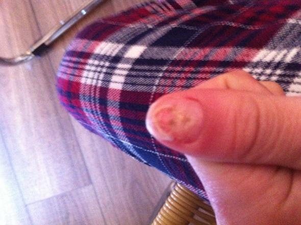das ist sehr ekelig :( - (Fingernägel, Halb ausgerissen)
