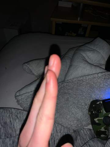 Fingerkuppe ist dick?