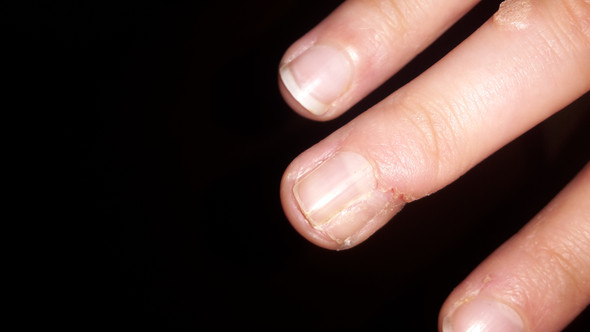 Fingernagel Gespalten Nagel Entfernen Operation Arzt Verletzung