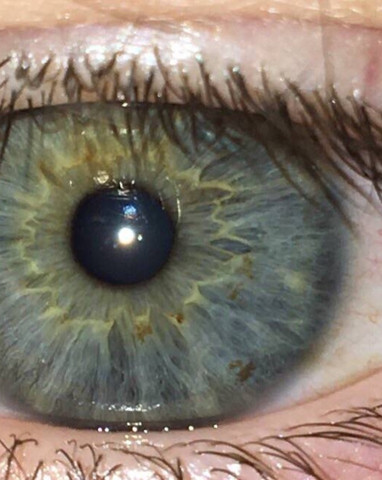 bild - (Augen, Flecken)