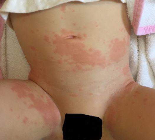 Flecken Ausschlag Beim Baby Krank Flecken Ausschlag Beim Baby Krank