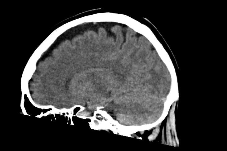 Frage An Die Radiologen Bezugl Schadel Ct Demenz Erkennbar Neurologie Gehirn Psychiatrie