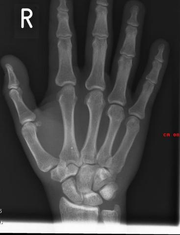 Hand - (Bruch, Röntgen, Fraktur)