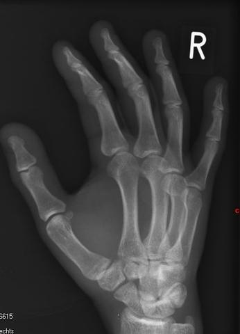 Hand - (Bruch, Röntgen, Fraktur)