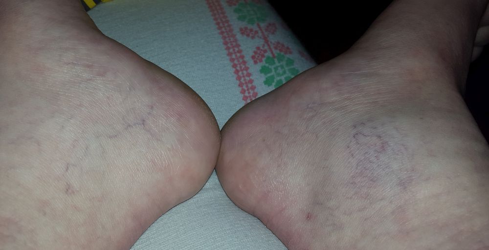 Metodi die Behandlung der Osteochondrose