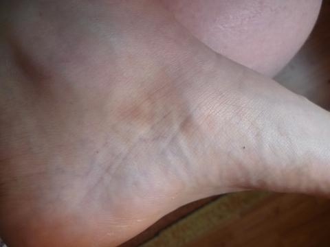 Fuss Umgeknickt Mit Innenkante Nach Oben Supination Fusse Verletzung Hamatom