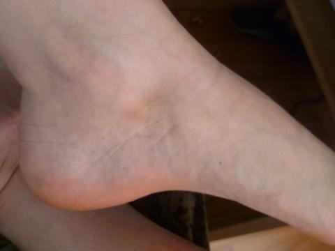 Fuss Umgeknickt Mit Innenkante Nach Oben Supination Fusse Verletzung Hamatom