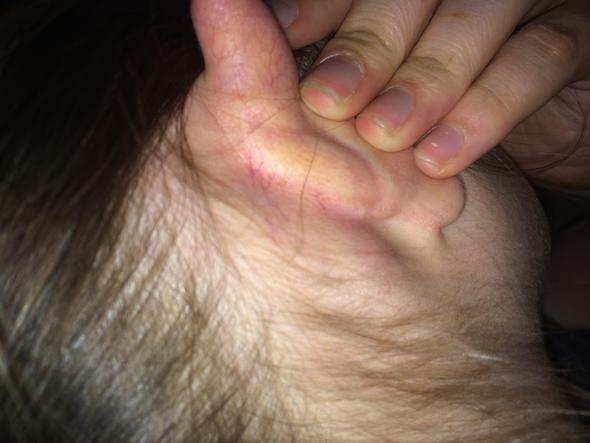 Fussball Bluterguss Hinterm Ohr 16 Weiblich Schwellung Fussball Bluterguss Hinterm Ohr 16 Weiblich Schwellung