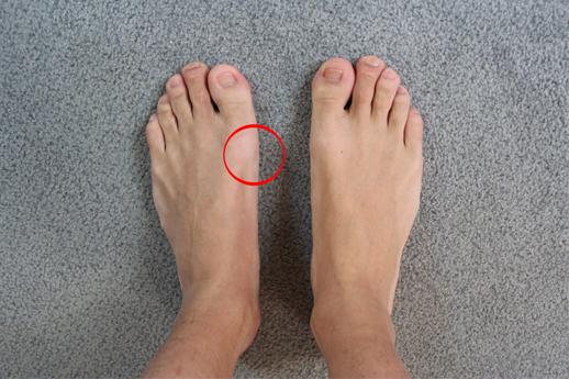 Fußfehlstellung Kritisch? (Mit Fotos) (Fußschmerzen, Zeh Fußfehlstellung Kritisch? (Mit Fotos) (Fußschmerzen, Zeh