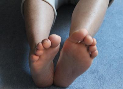 Füße von vorne 3 - (Fußschmerzen, Zeh, Fehlstellung)
