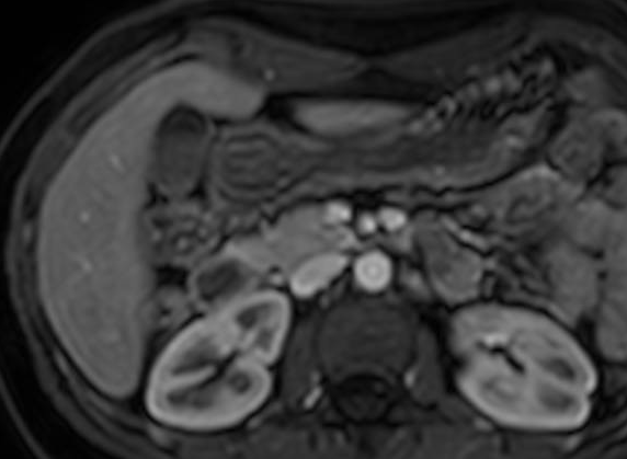 Gallenblase Sludge Entzundung Gallenblase Sludge Entzundung