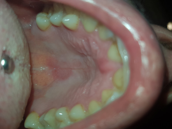 Gaumen Mund Gaumen Mund