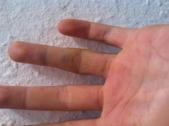 Gebrochen Aber Kein Gips Schmerzen Finger Gebrochen Aber Kein Gips Schmerzen Finger