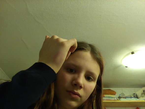 Welche Symptome Bei Mittelhandknochenbruch Hand Bruch Fraktur Welche Symptome Bei Mittelhandknochenbruch Hand Bruch Fraktur