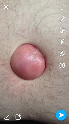 Hernien - (bauchnabel, nabelbruch, Nabel)