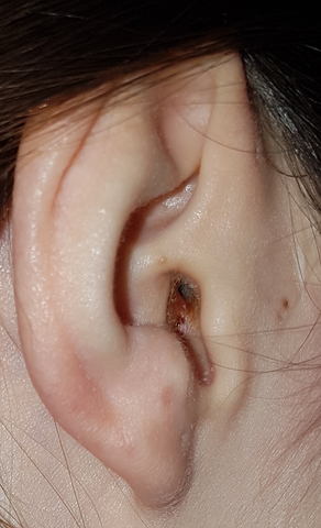 Gehorgangsentzundung Entzundung Ohr Juckreiz Gehorgangsentzundung Entzundung Ohr Juckreiz