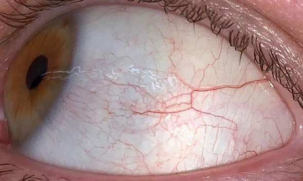 Gelbe Augen / Sklerenikterus? (Leberwerte)