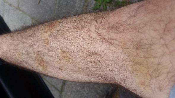 Woher Kommen Die Gelben Flecken An Den Beinen Beine Woher Kommen Die Gelben Flecken An Den Beinen Beine