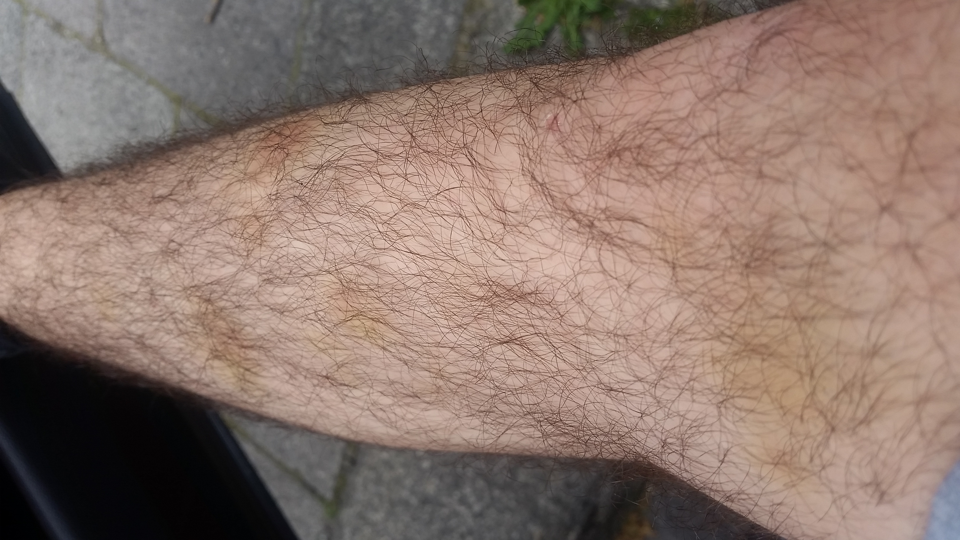 Woher Kommen Gelben Flecken An Den Beinen Beine Woher Kommen Gelben Flecken An Den Beinen Beine