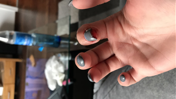 Gelnägel (meine eigenen Nägel nur mit Gel modelliert kein Tip): Nagel abgebrochen und Nagelbett fehlt die Hälfte. Was nun und wie lange dauert das Nachwachsen?