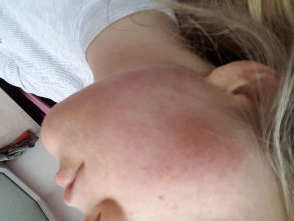 - (Haut, Gesicht, Dermatologie)