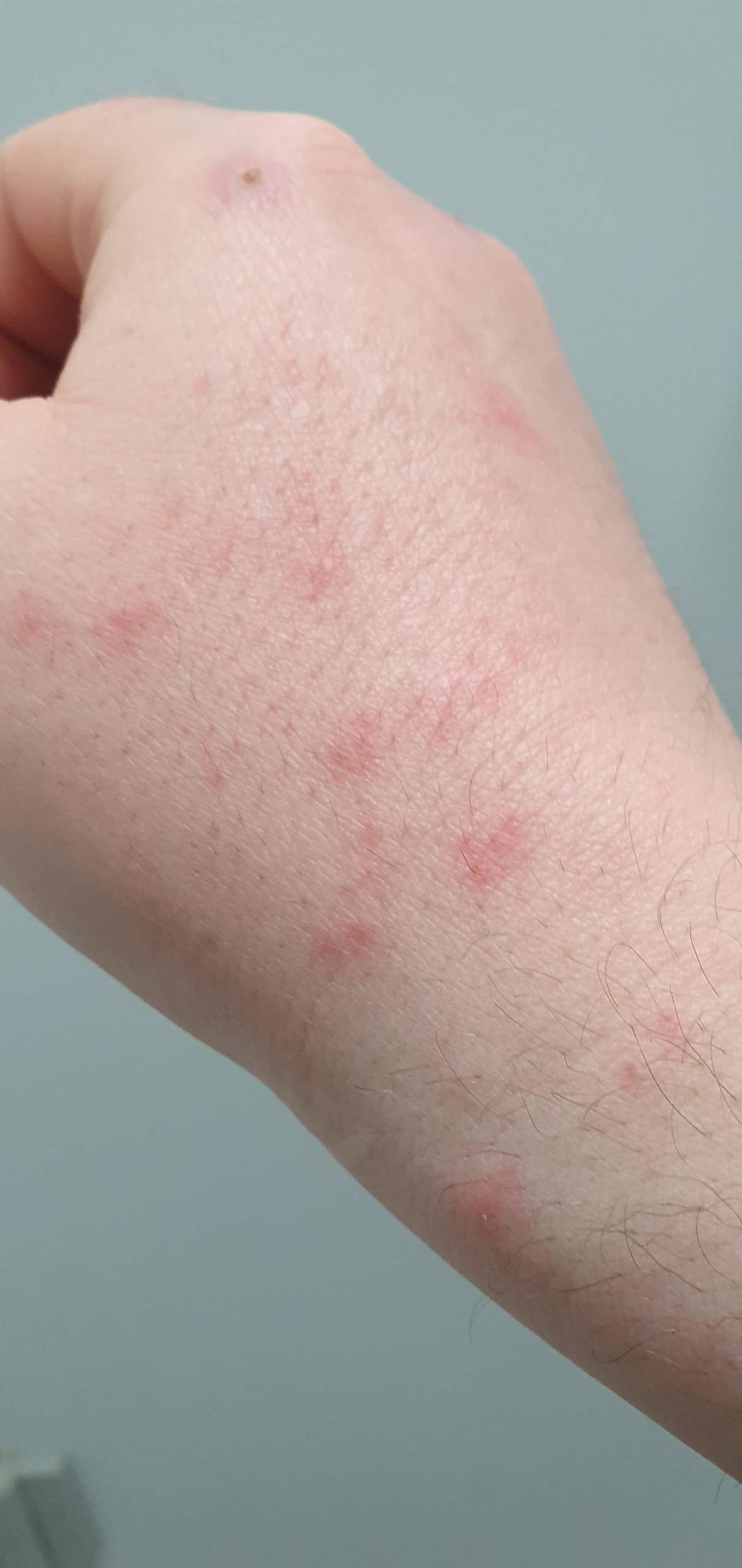 Geschlechtskrankheiten pickel am glied