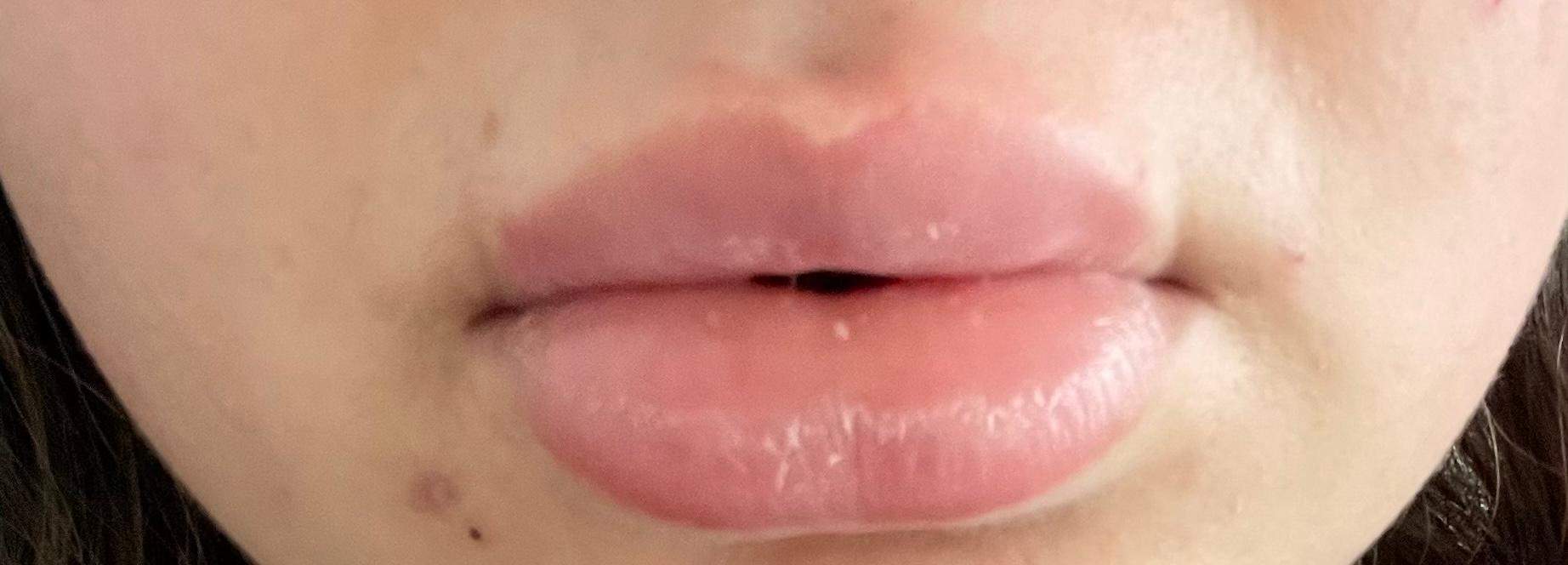 Geschwollene Lippen Bluten | Was hilft bei einer geschwollenen Lippe ...