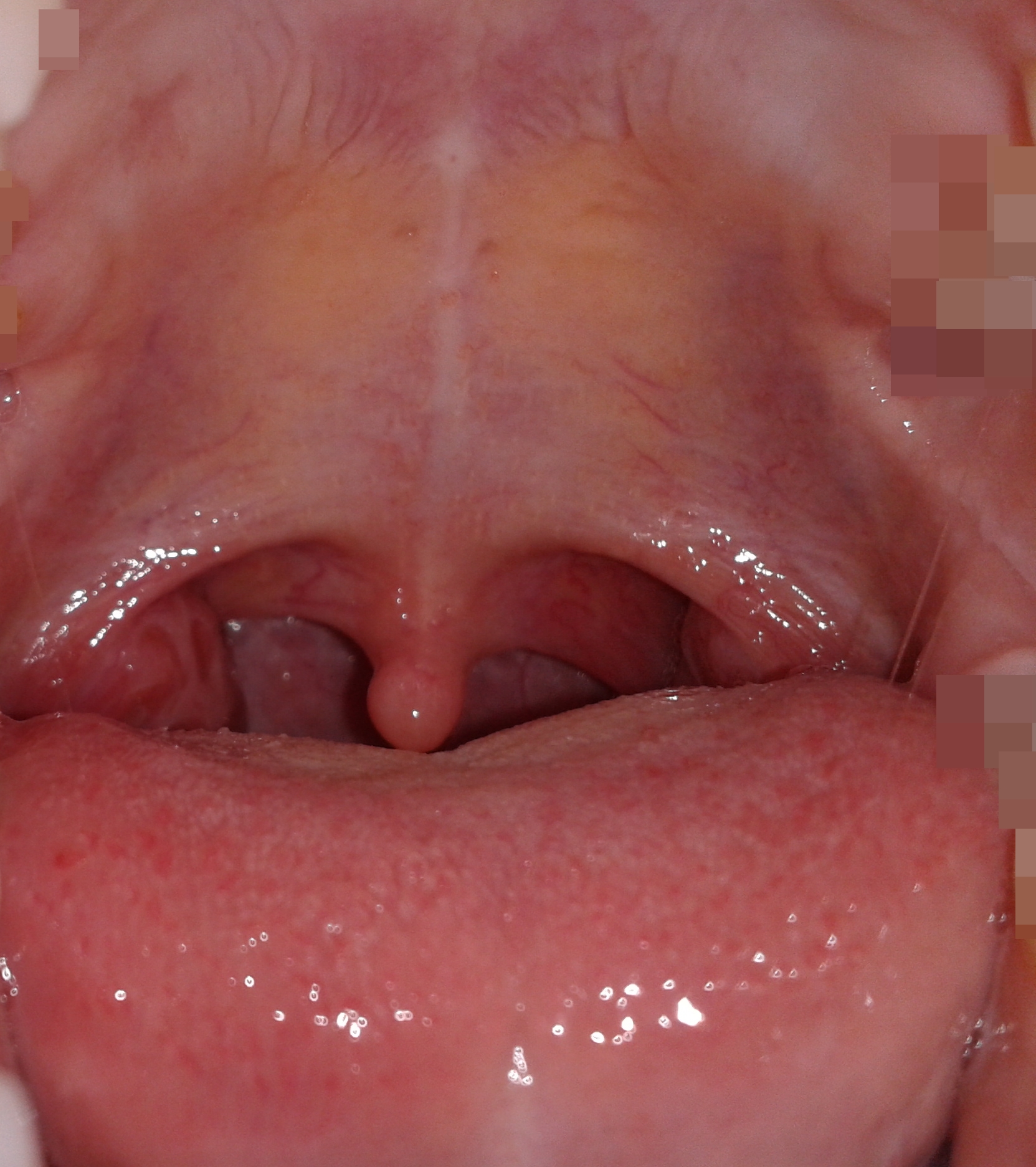 Geschwollene Mandel? (Schwellung, Hals, Mandeln) Geschwollene Mandel? (Schwellung, Hals, Mandeln)