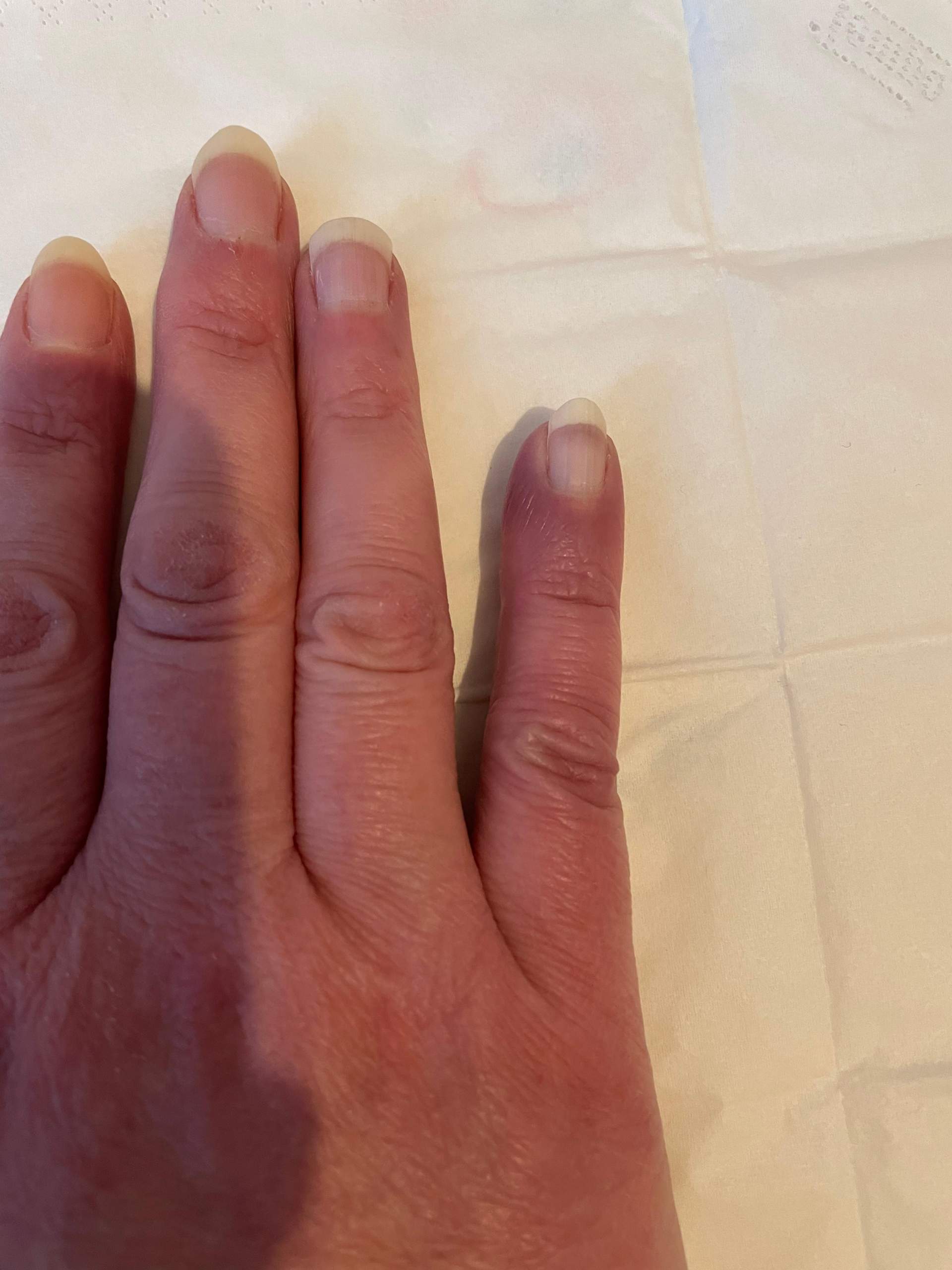 Geschwollener Finger, was kann es sein? (Rheuma, geschwollen)