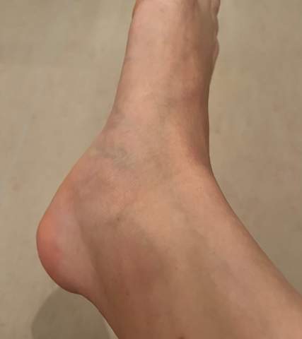 Geschwollener Fuß?