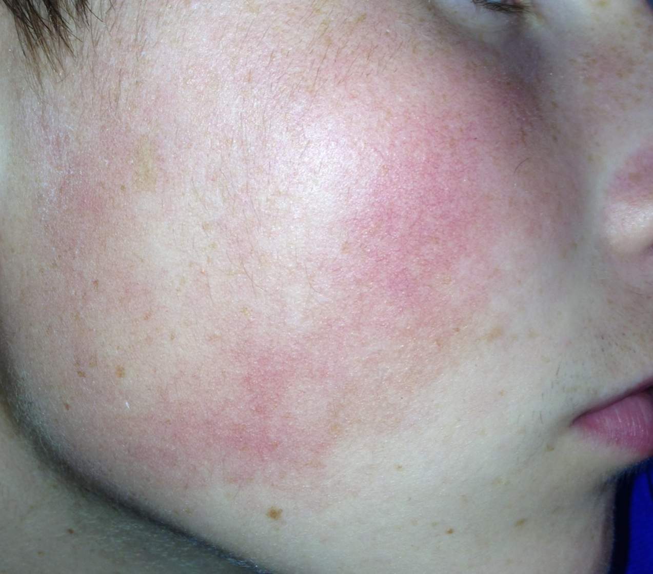 Gesichtshaut gereizt? Allergie? Rosazea? (Haut, Gesicht, Hautpflege)