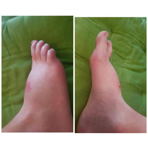 Gips Obwohl Kein Bruch Vorliegt Fusse Schwellung Gips Obwohl Kein Bruch Vorliegt Fusse Schwellung
