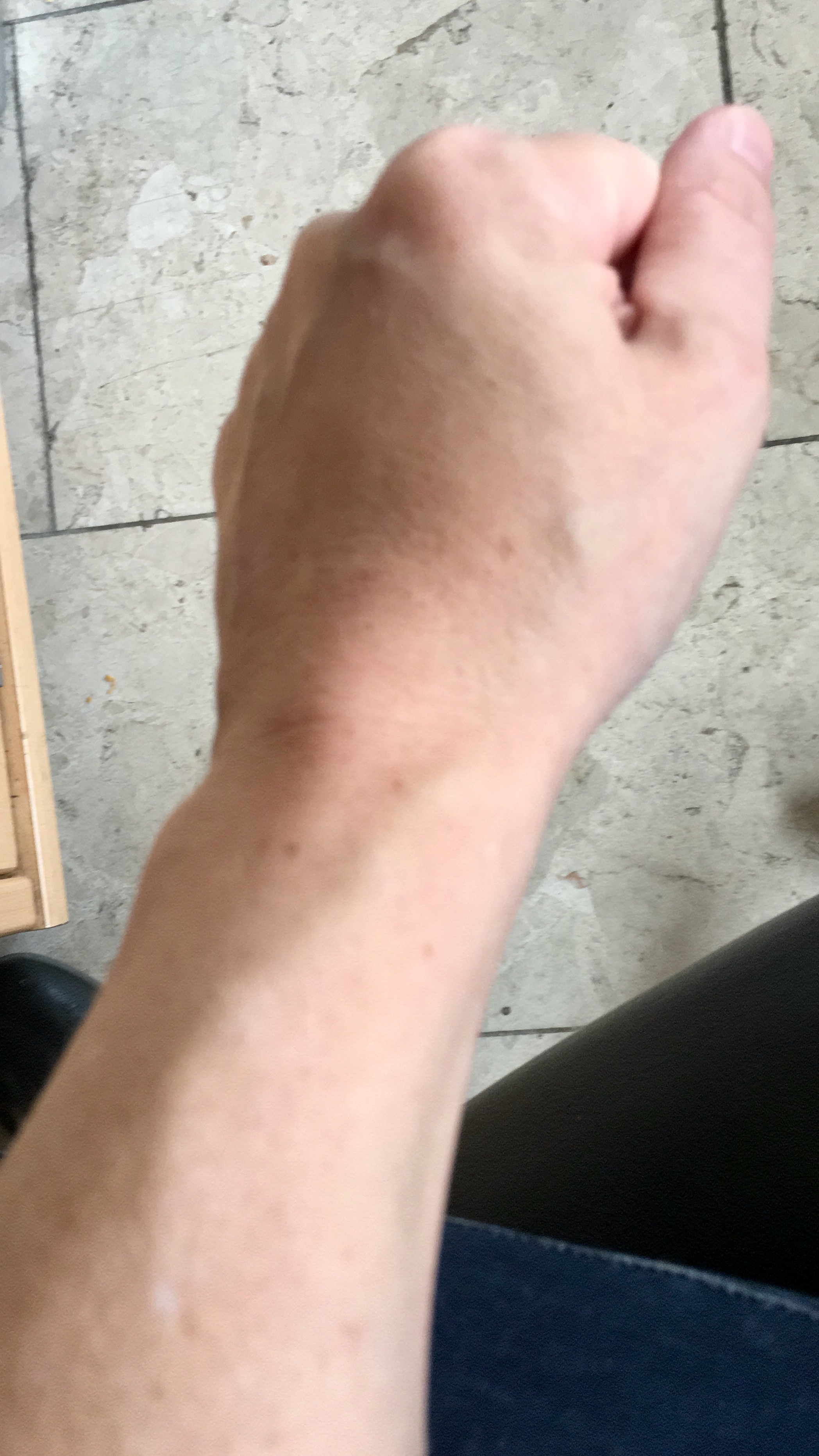 Große Angst vor Thrombose und mehr, Gnubbel auf Vene.. mit Bild ? (Blut Große Angst vor Thrombose und mehr, Gnubbel auf Vene.. mit Bild ? (Blut