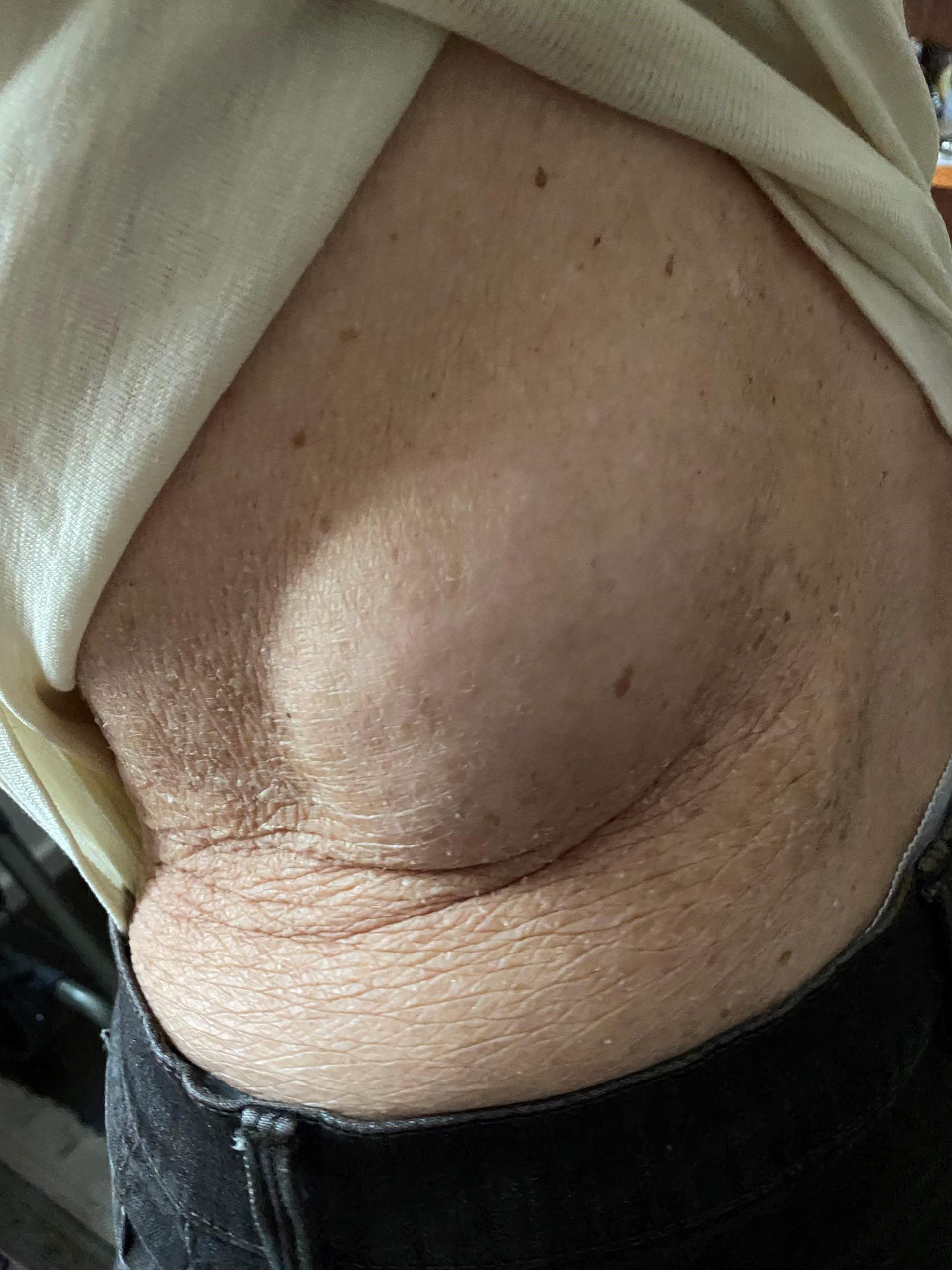 Beule große Beule am unteren Rücken, linksseitig - was kann das sein?