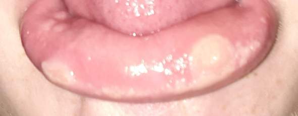 Große Blasen an geschwollener Lippe?