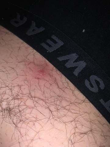 Grosser Pickel Unterm Bauchnabel Schmerzen Haut Grosser Pickel Unterm Bauchnabel Schmerzen Haut