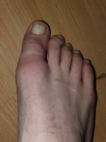 Grosser Zeh Gebrochen Oder Was Da Los Fusse Grosser Zeh Gebrochen Oder Was Da Los Fusse
