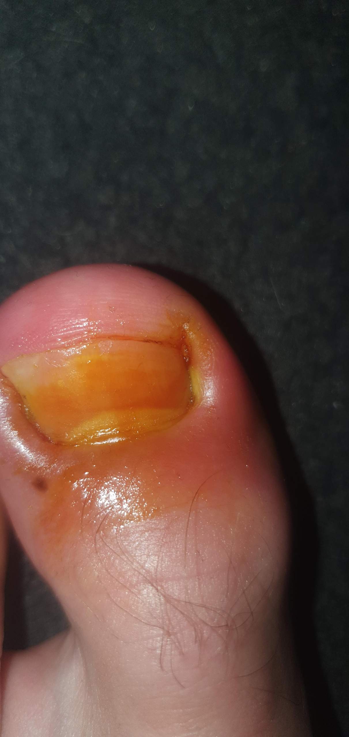 Großer Zeh Nagel Wall entzündet Arzt oder nicht? (Füße, Entzündung, nägel)